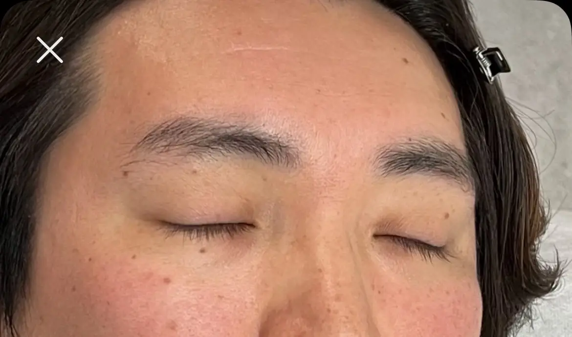 施術前写真
